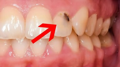 Sâu răng cửa ở người lớn &#8211; Vấn đề không hiếm gặp