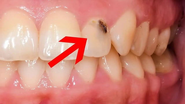 Sâu răng cửa ở người lớn &#8211; Vấn đề không hiếm gặp