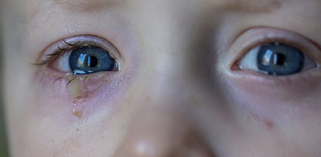 Trẻ bị đau mắt có ghèn vàng: Bệnh lý liên quan và cách xử lý