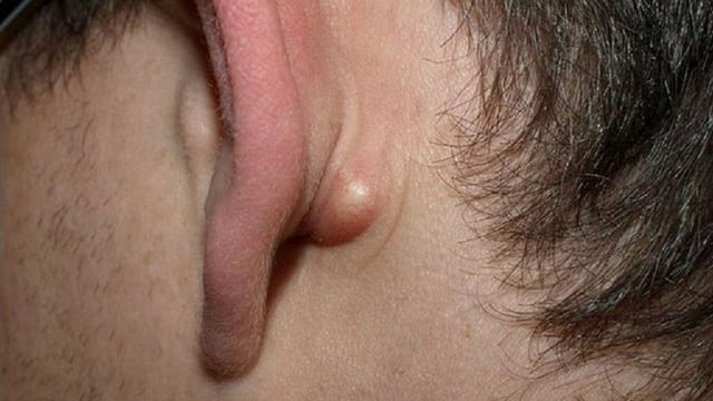Những điều cần biết về u bã đậu ở tai