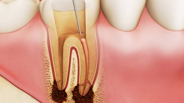 Viêm tủy chân răng &#8211; Nhận biết và điều trị đúng cách