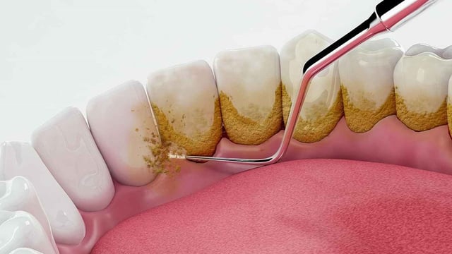 Bị vôi răng &#8211; Nguyên nhân, tác hại và cách phòng ngừa