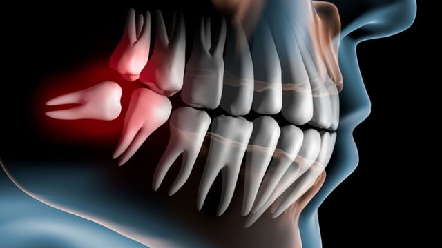 Răng trong cùng hàm dưới bị sâu &#8211; Nguyên nhân và Điều trị