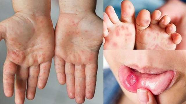 Bác sĩ và lời khuyên về cách chữa tay chân miệng cho trẻ nhỏ