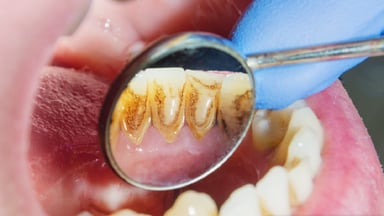 Tự làm sạch cao răng tại nhà &#8211; Cân nhắc trước khi thực hiện