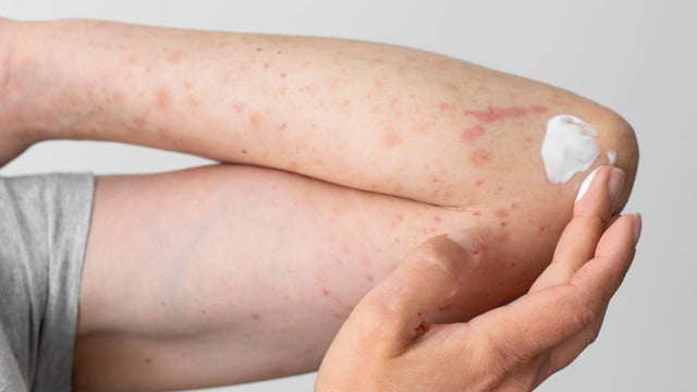 Tiêm vắc-xin bị nổi mẩn đỏ: Nguyên nhân và cách xử lý