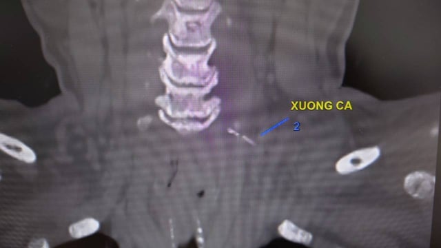 Trị hóc xương cá hiệu quả: Hướng dẫn toàn diện