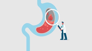 Ợ chua nguyên nhân là gì, chẩn đoán và điều trị ra sao?