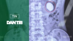 Hy hữu sỏi có hình dạng như quả trứng xuất hiện ở thận của chàng trai 22 tuổi