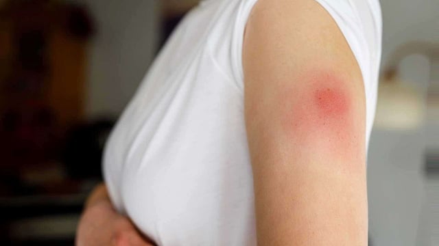 Những phản ứng phụ khi tiêm vacxin cần biết để bảo vệ sức khỏe