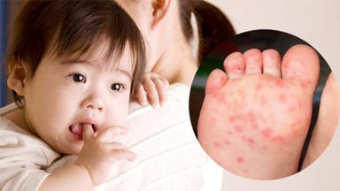 Dấu hiệu bị tay chân miệng ở trẻ em &#8211; Cha mẹ lưu ý
