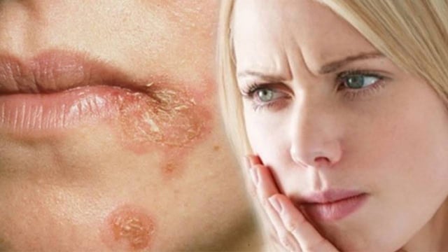 Nấm ở mép miệng &#8211; Nguyên nhân và giải pháp