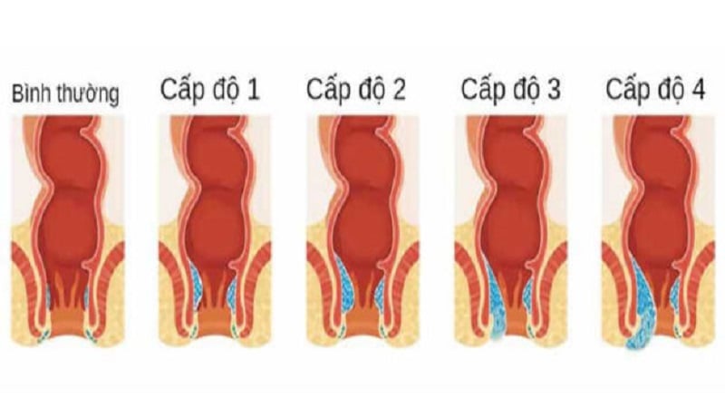 Trĩ nội có cần phẫu thuật, điều trị cần chú ý điều gì?