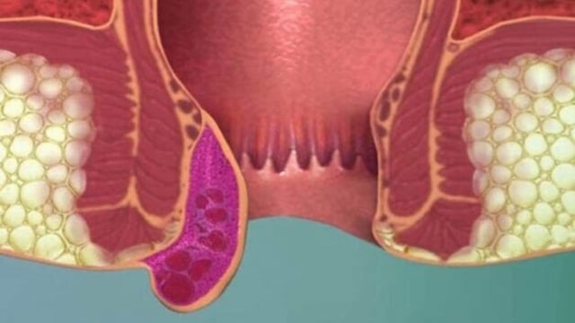 Bệnh trĩ có lây không, nguyên nhân và cách điều trị hiệu quả