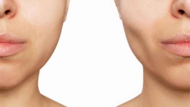 Niềng răng bị hóp má &#8211; Nguyên nhân và cách khắc phục