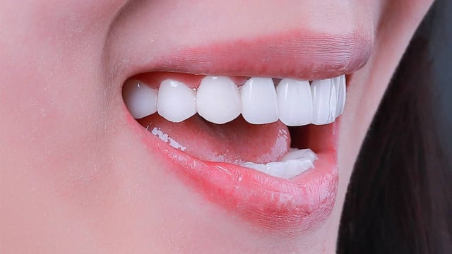 Tẩy trắng răng &#8211; Phương pháp và thời điểm thực hiện