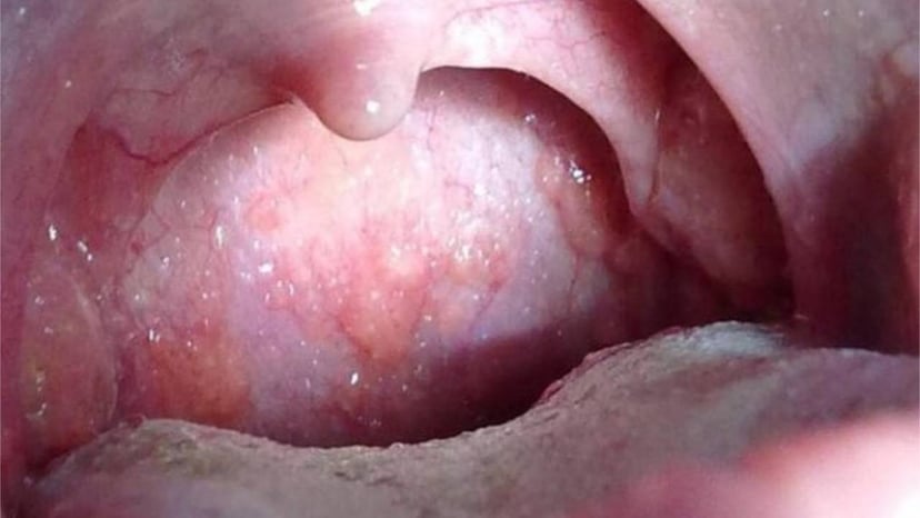 Viêm họng hạt mạn tính &#8211; Những điều bạn cần biết