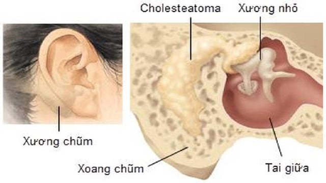 Viêm tai xương chũm có cholesteatoma &#8211; Bệnh lý cần cảnh giác
