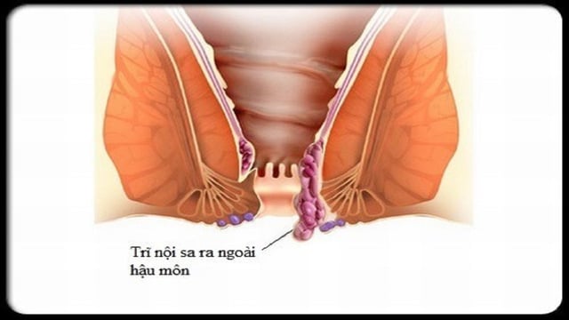 Bệnh trĩ là do đâu: Nguyên nhân, triệu chứng và cách điều trị hiệu quả