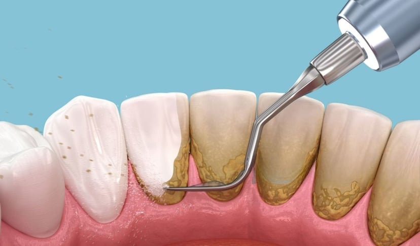 Lấy cao răng và sự tác động đến sức khỏe răng miệng