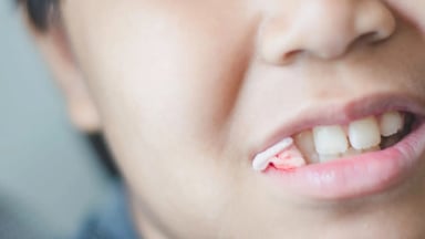 Nhổ răng khôn khi nào lành &#8211; Giải đáp cho bạn