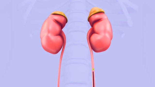 Những phương pháp tán sỏi niệu quản qua nội soi