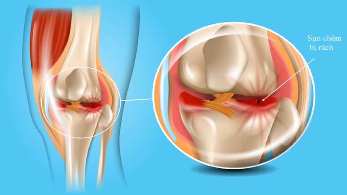 Biểu hiện rách sụn chêm đầu gối, chẩn đoán và điều trị