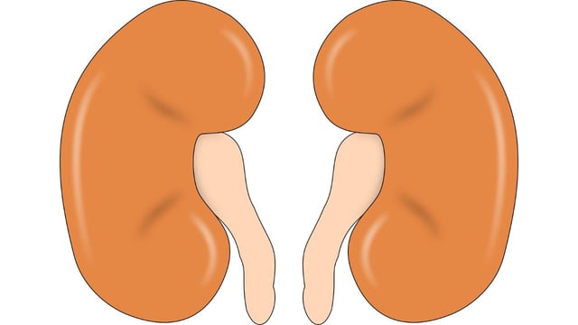 Vì sao bị đài bể thận giãn độ 3: Cơ chế và các yếu tố nguy cơ