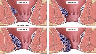 Điều trị bệnh trĩ như thế nào: Khuyến cáo dành cho người bệnh trĩ