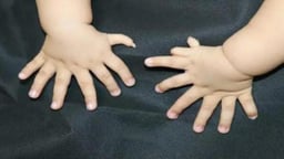 Phẫu thuật thừa ngón tay cái và những điều cần biết