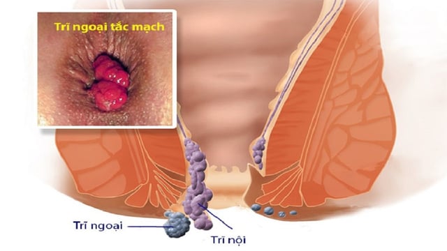 Trĩ ngoại tắc mạch: Hiểu đúng để điều trị hiệu quả
