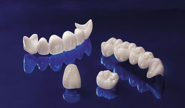 Ưu điểm nổi bật của trồng răng sứ Titan trong phục hình răng
