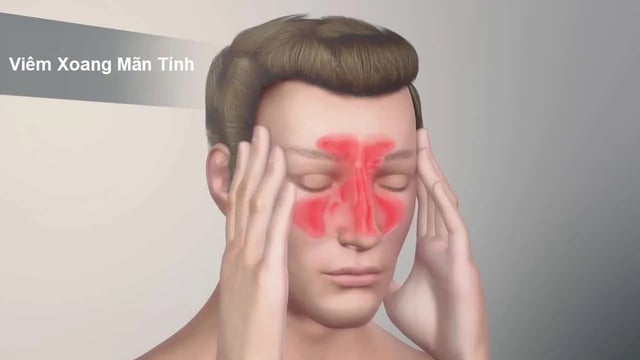 Viêm xoang mạn tính &#8211; Chẩn đoán và điều trị