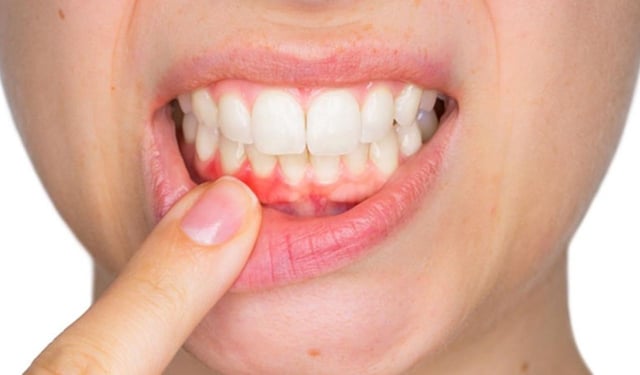 Đau răng lợi: Nguyên nhân và cách điều trị hiệu quả
