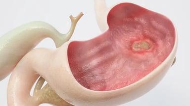 Loét dạ dày triệu chứng: Nhận biết sớm để điều trị hiệu quả