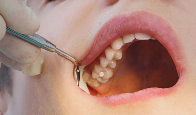 Nhổ răng hàm trên: Quy trình, chi phí và những điều cần biết