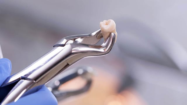 Giải đáp về việc nhổ răng khôn số 8 có nguy hiểm không