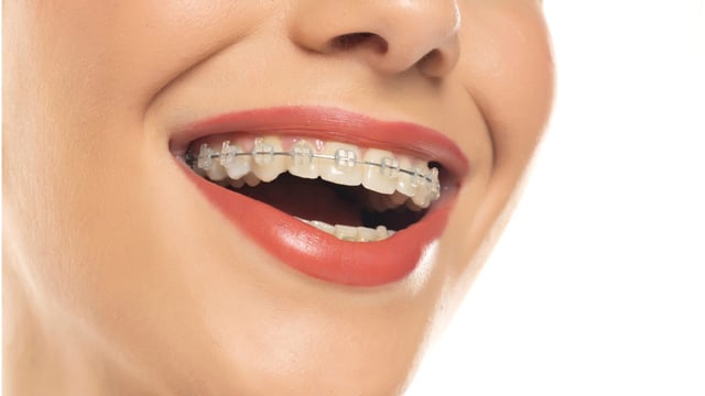 Niềng răng mất bao lâu và câu trả lời chi tiết