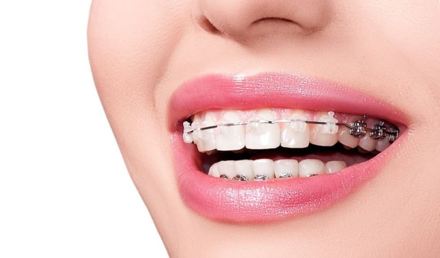 Niềng răng mọc lệch là gì? Quy trình và những điều cần biết