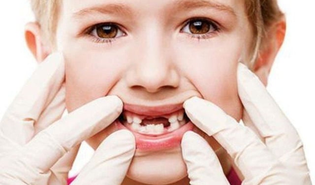 Nguyên nhân và cách phòng tránh sâu răng em bé hiệu quả