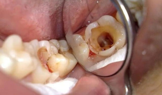 Sâu răng hở tủy là gì? Nguyên nhân và cách điều trị hiệu quả