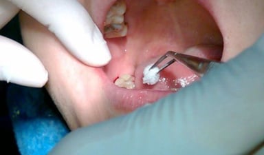 Sâu răng khôn: Dấu hiệu nhận biết và cách phòng ngừa
