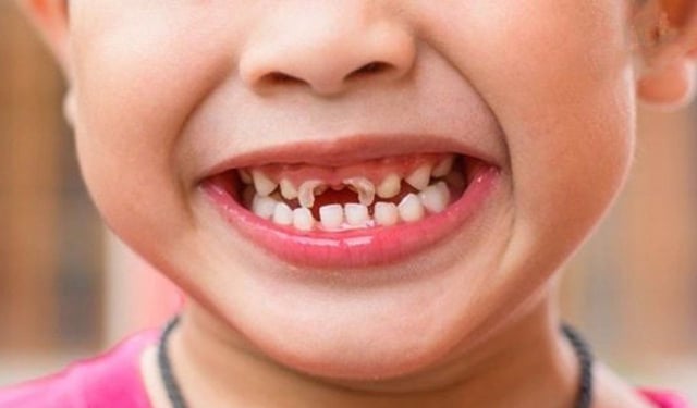 Dấu hiệu nhận biết và giải pháp xử lý sâu răng sữa kịp thời