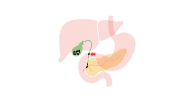 Sỏi ống mật chủ: Dấu hiệu nhận biết và biến chứng nguy hiểm