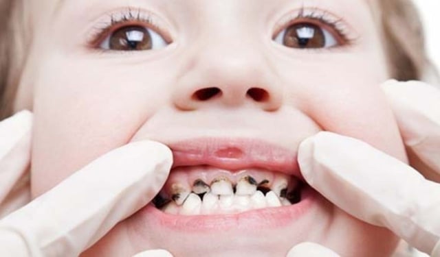 Các phương pháp trị răng sâu giúp giảm đau nhanh chóng