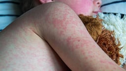 Bệnh sởi ở trẻ nhỏ &#8211; Ba mẹ chớ bỏ lỡ thời điểm vàng điều trị