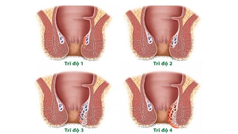 Laser Diode đột phá trong các cách chữa trĩ nội độ 2