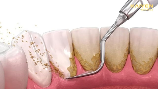 Lấy cao răng không đau: Bí quyết giảm ê buốt tối đa