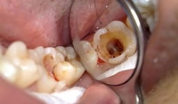 Hậu quả tiềm ẩn khi người bị sâu răng chậm trễ điều trị