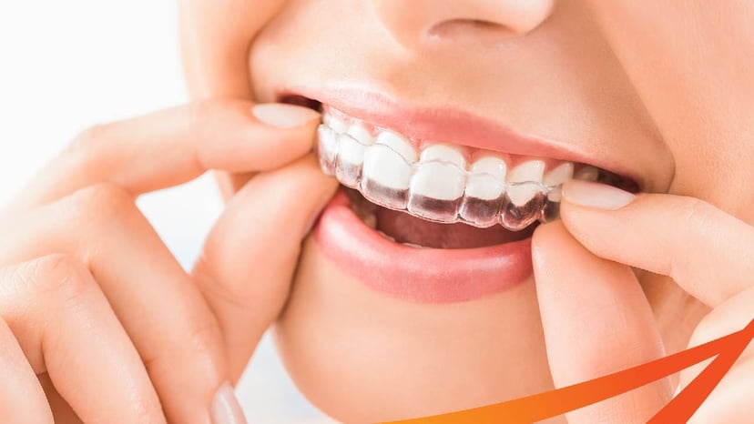 Niềng răng trong suốt Invisalign &#8211; Những điều nên biết sớm